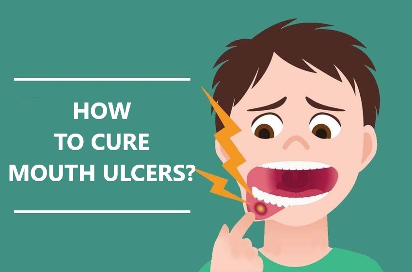 how-to-cure-mouth-ulcers