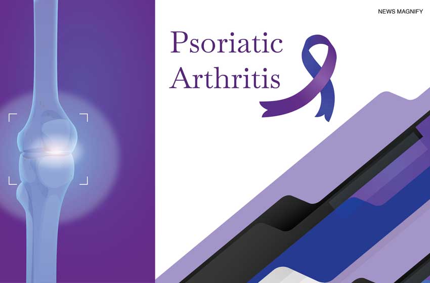  Psoriatic Arthritis: An Easy And Detailed Guide For You