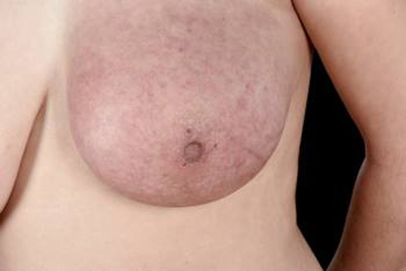 breast-cancer-symptoms-infection