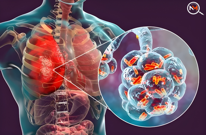  Pneumonia Symptoms Not To Be Confused With Flu, Covid, Dengue