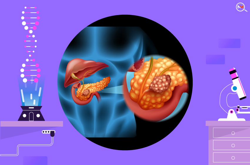  Pancreatic Cancer Is Hereditary Or Not? Is Genetic Testing Necessary?